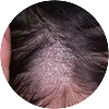 Fungal Infections