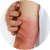 Skin Irritation