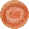 Ringworm (Tinea Corporis)