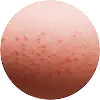 Allergic Reactions